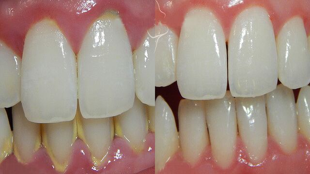 Diş tartarına doğal çözüm