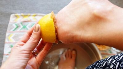 Topuk çatlaklarına limon çözümü!