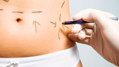 Lazer lipoliz nedir?