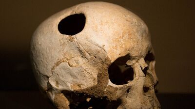 Eski tedavi yöntemleri içinizi ürpertecek!