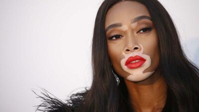 Vitiligo modeller