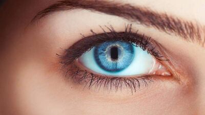 Sadece böbrekte değil, gözde de taş olur!