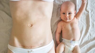 Sezaryen kesisi ile ilgili bilmeniz gerekenler