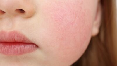 Gıda alerjileri bağırsak ilişkisi