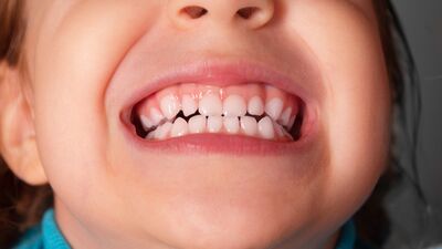 Tecrübelerim: Çocuklarda diş gıcırdatma