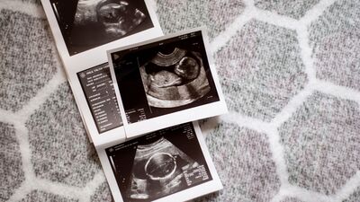 Ultrason terimleri ne anlama gelir?