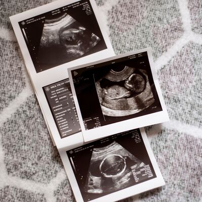 Ultrason terimleri ne anlama gelir?