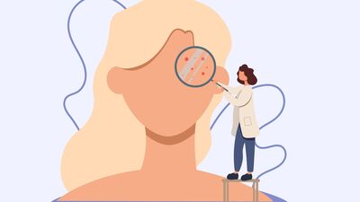 Yüzünüzdeki sivilceler ne anlama geliyor?