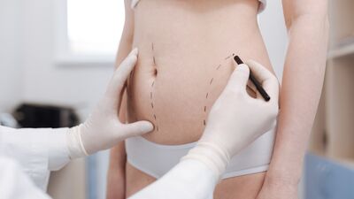 Liposuction hakkında merak edilenler