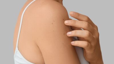 Cilt kanseri: Kadın ve erkekte farklı bölgelerde yaygın