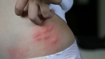 Beni ne ısırdı? İşte 10 böcek ısırığı...