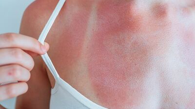 Güneş yanığı ne zaman geçer?