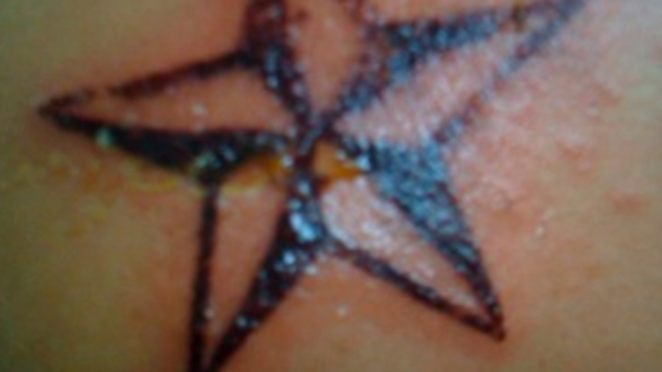 Geçici dövmeler alerji nedeni