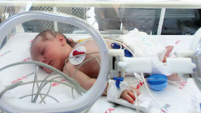 'Mavi bebek' ilk ameliyatını oldu