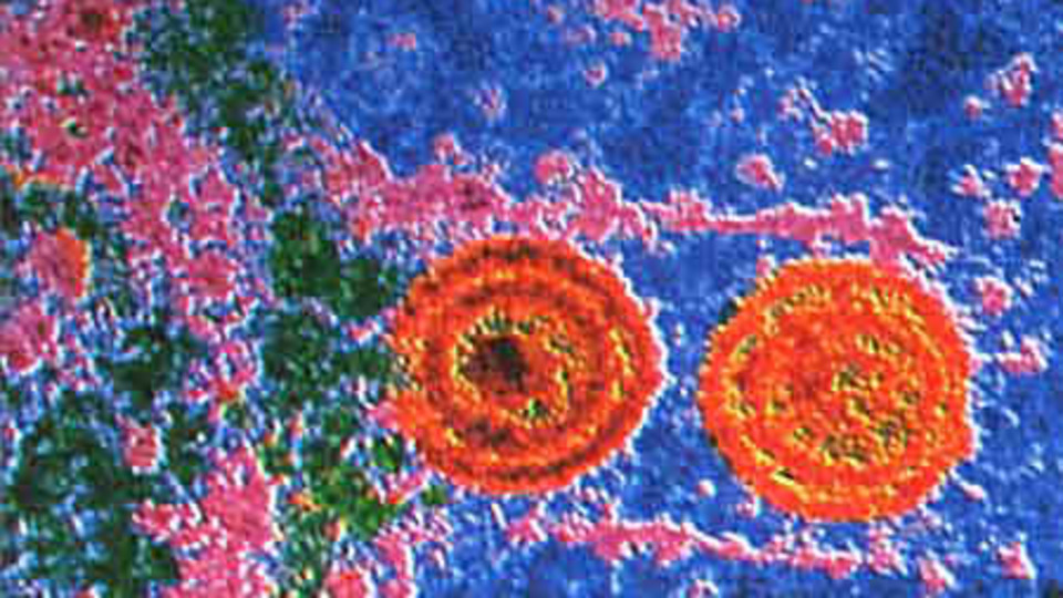 Herpes virüsüyle kanser tedavisi
