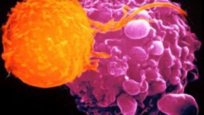 Kanser en çok nerede öldürücü?