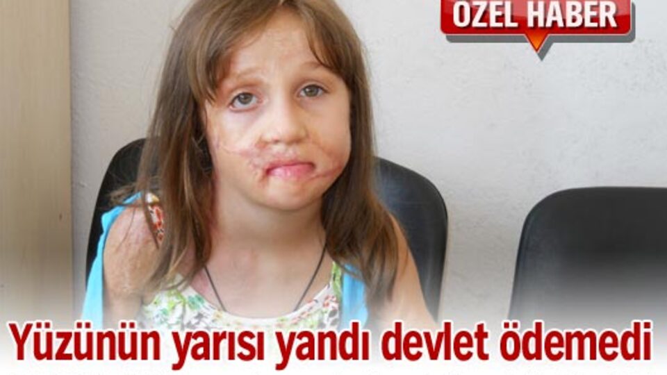 Yüzünün yarısı yandı devlet ödemedi