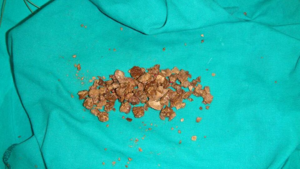 Böbrek taşını beslenmeyle önleyin