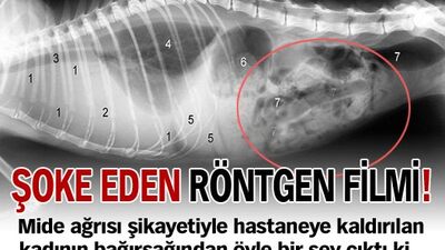 Bağırsağından vana kolu çıktı!