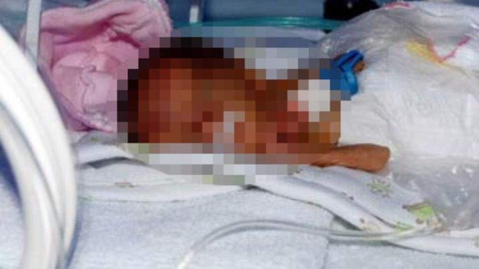 Parmak bebek yaşam savaşını kaybetti!