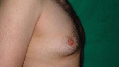 Erkeklerde meme kanseri riski