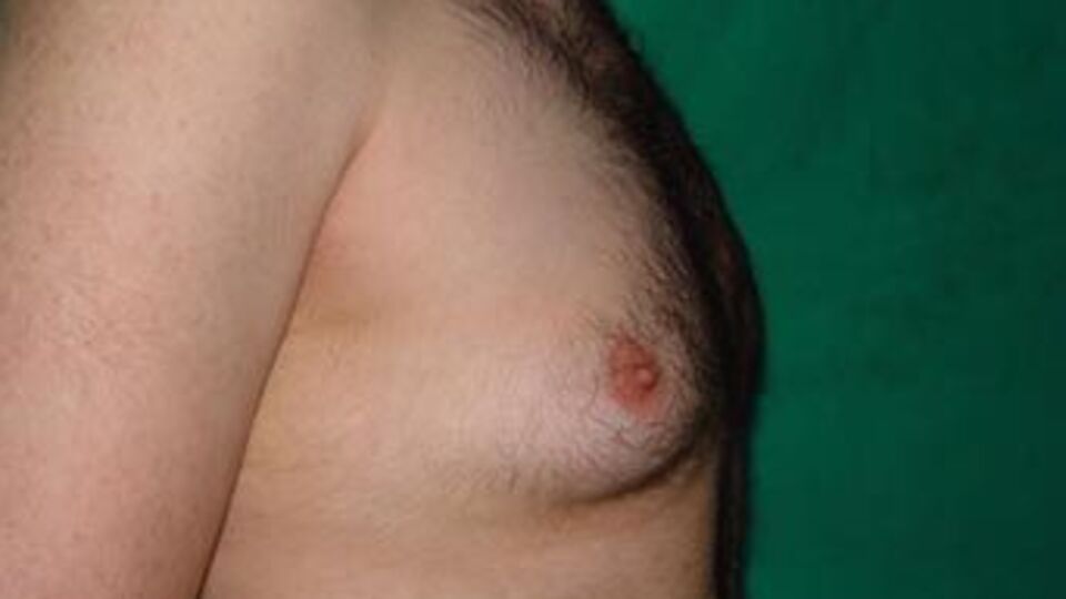 Erkeklerde meme kanseri riski