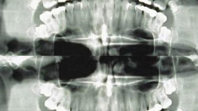 Diş röntgenindeki büyük tehlike!