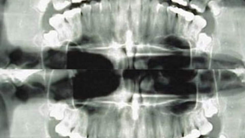 Diş röntgenindeki büyük tehlike!