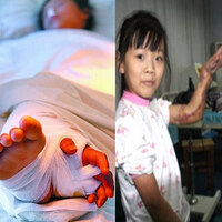 Kopuk kolunu 3 ay ayağında taşıdı!