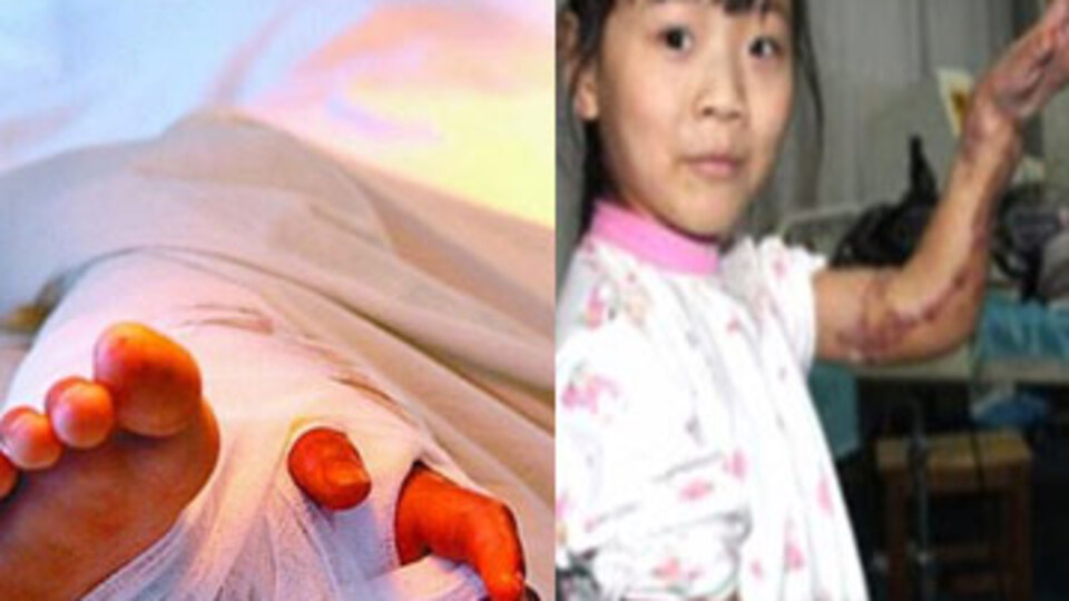 Kopuk kolunu 3 ay ayağında taşıdı!