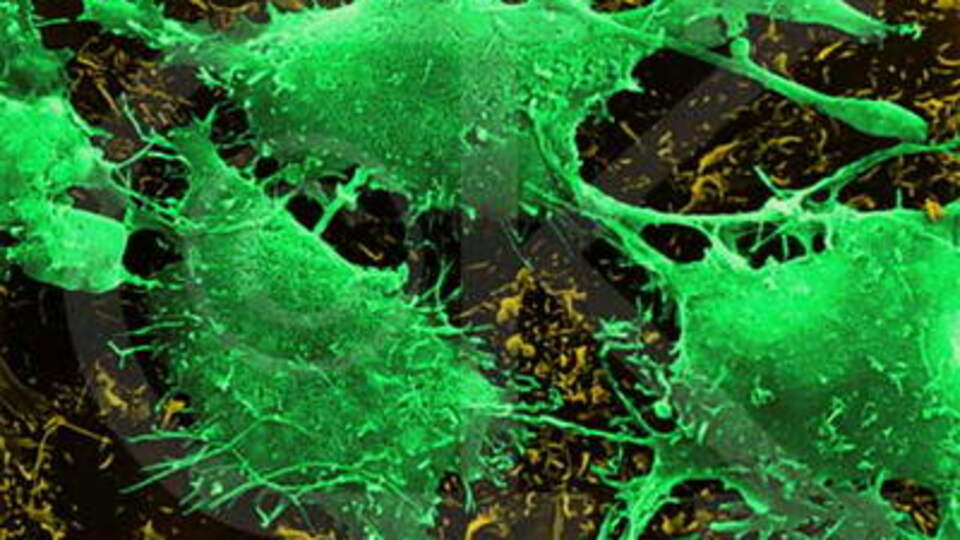 Pankreas kanseri için kimler risk altında?