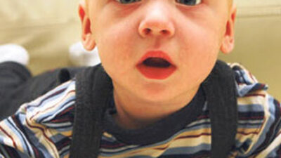 Bıngıldağı çökük ya da kabarık mı?