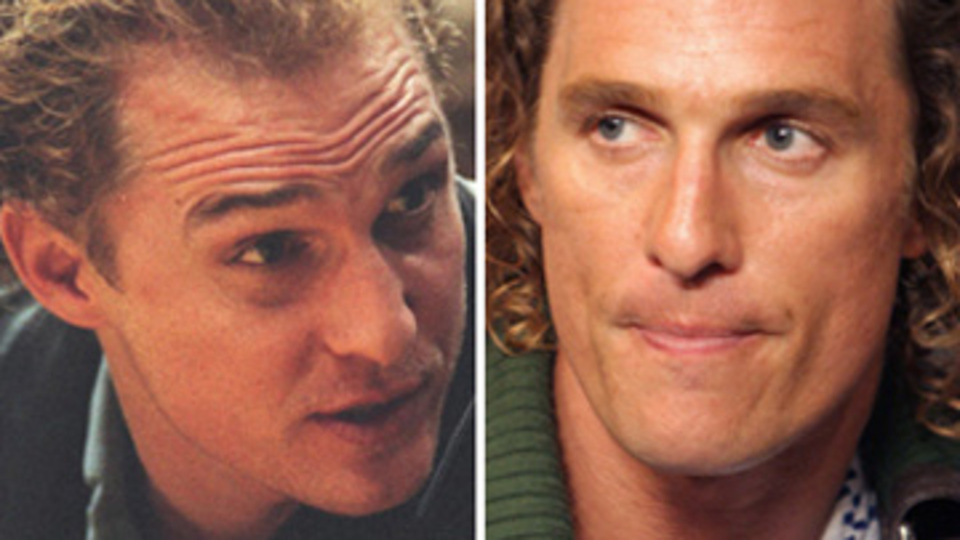 Saç ektiren ünlüler GALERİ