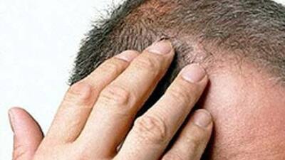 Günde kaç tel saçınız dökülüyor?