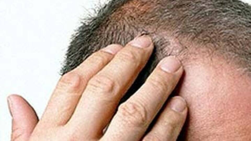 Günde kaç tel saçınız dökülüyor?