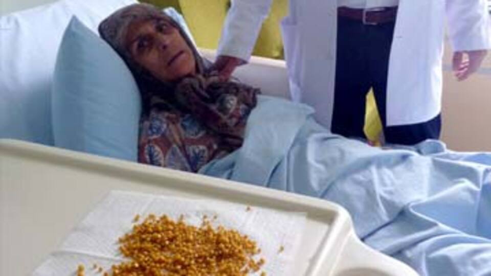 Safra kesesi değil sanki taş ocağı!