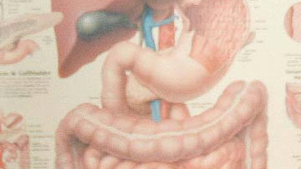 İleri evre mide kanserinde hayat kurtaran ameliyat