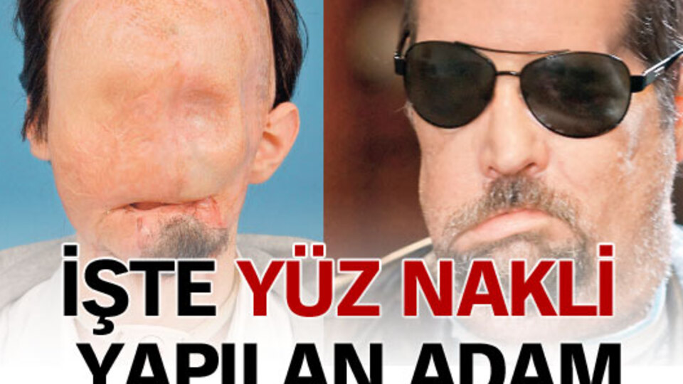 İşte yüz nakli yapılan adam!