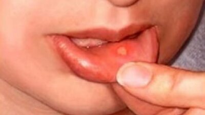 Sizin de ağzınızın içinde yara var mı?