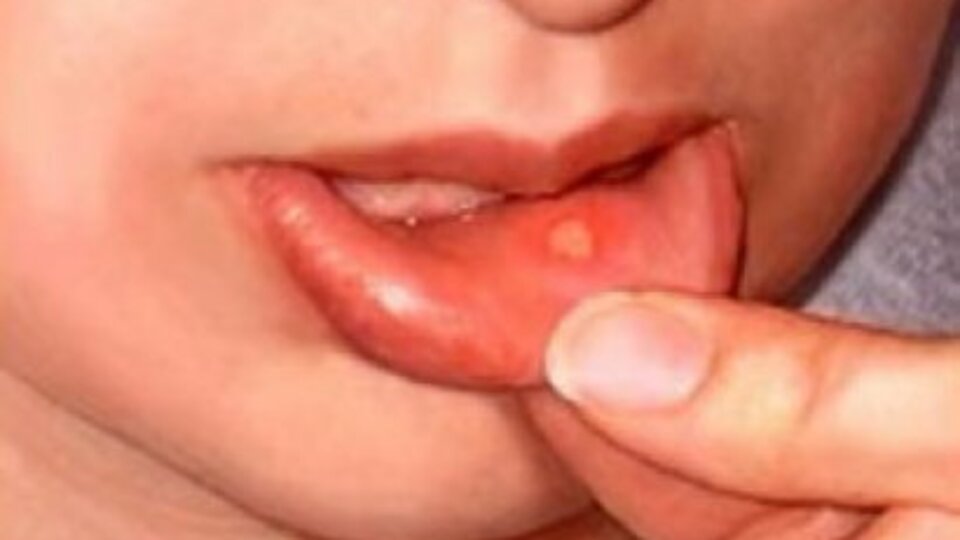 Sizin de ağzınızın içinde yara var mı?