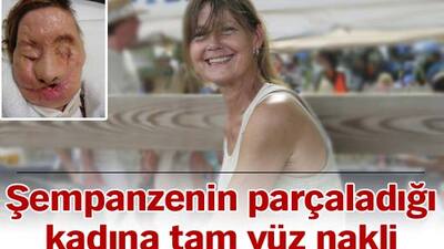Şempanzenin parçaladığı kadına tam yüz nakli