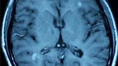 MS'le ilgili yeni keşif