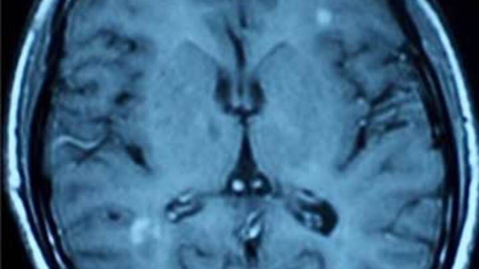 MS'le ilgili yeni keşif