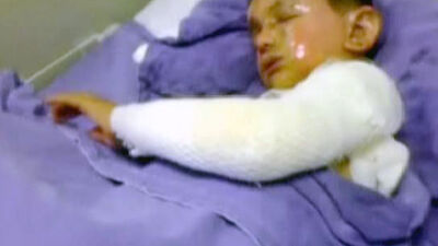 Molotofla yanan çocuk yaşam mücadelesi veriyor