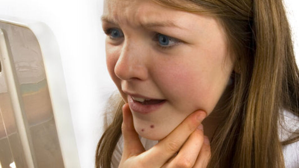 Neden sivilce çıkıyor?