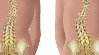 Omurga kırılmasına karşı kalsiyum ve egzersiz önerisi