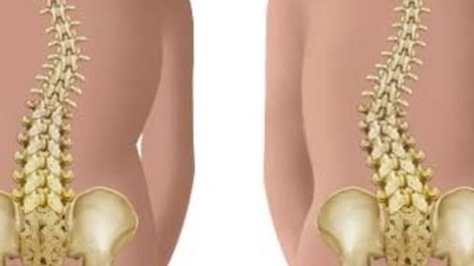 Omurga kırılmasına karşı kalsiyum ve egzersiz önerisi