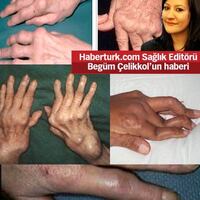 Sigarayla direkt bağlantılı!