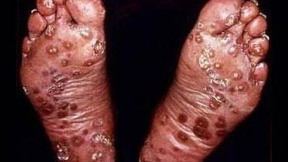 Tehlikeli gen mutasyonu bulundu!