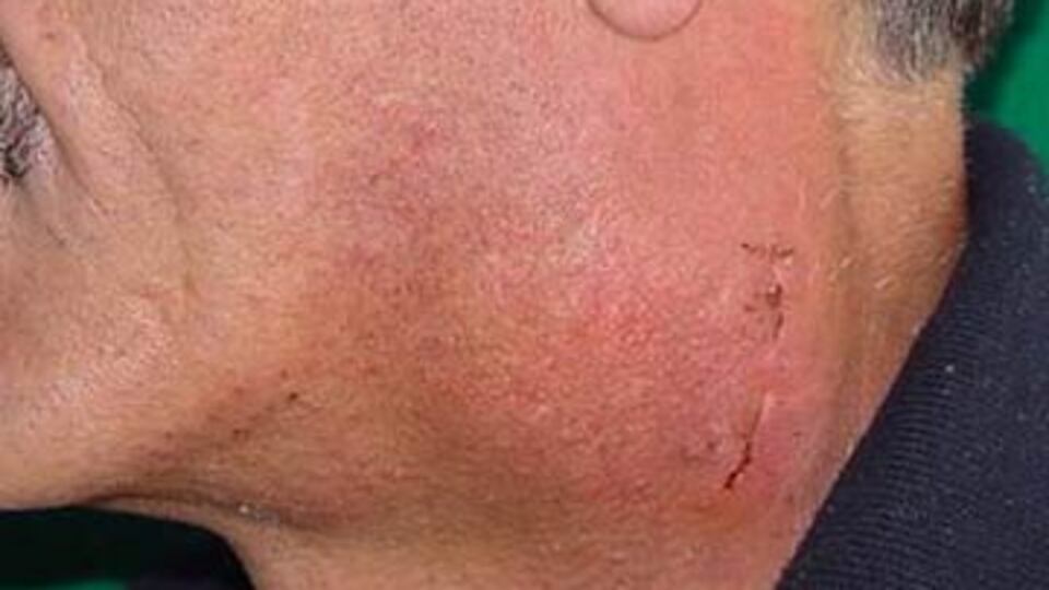 Sigara lenfomaya neden oluyor